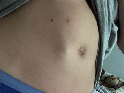 Enoxaparin (lovenox) injection site....scary lump!! - Glow Community