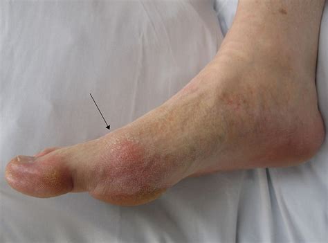 How Gout can affect Children ~ Medical Health