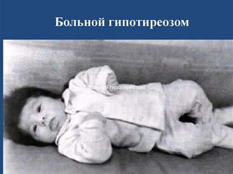 Врожденный гипотиреоз - презентация онлайн