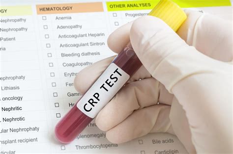 C-reactive protein (CRP) test: High and low levels, and normal range