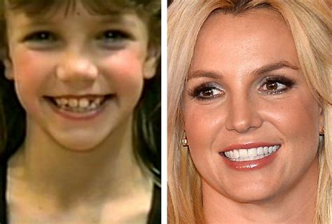 Britney Spears Teeth Before After