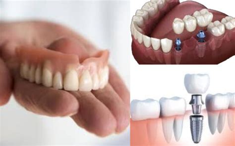 Dental Implants Vs Dentures – The Pros and Cons – PRV Dental