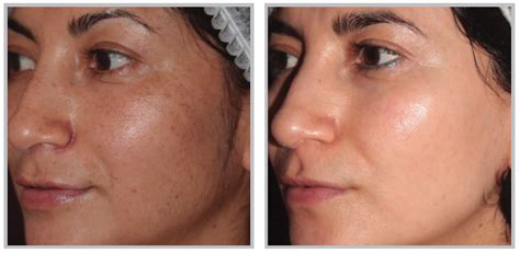 BBL® Forever Young - BB Aesthetic Medical Spa