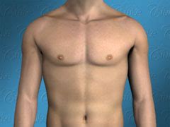 Classic Gynecomastia - LA Gynecomastia