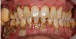 calcium buildup on teeth how to get rid