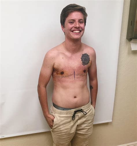 My boyfriend is 1 week post op today! (Top surgery) : r/ftm