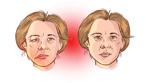 Complications of myasthenia gravis | Vinmec