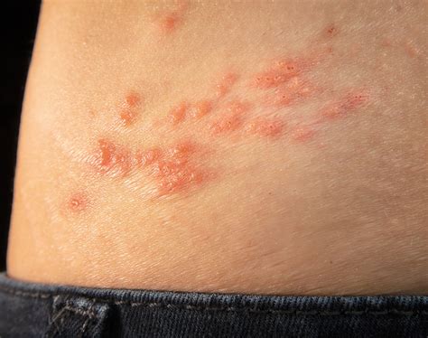 multiple sclerosis  skin rashes seche