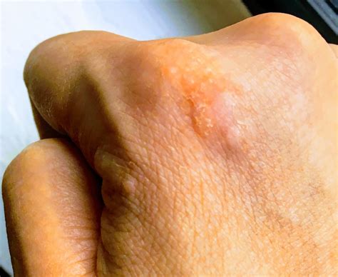 Ways to provoke your entire immune system? : r/Warts