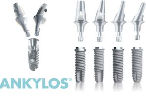 Импланты Ankylos, особенности имплантации Анкилоз