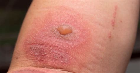 What Do Blister Beetle Bites Look Like? - IMP WORLD