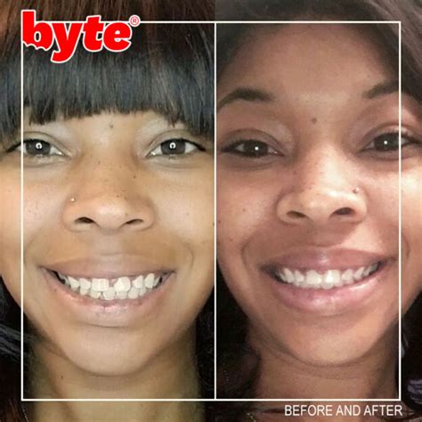 Byte Before & After Photos: Pics of Real Customer Results