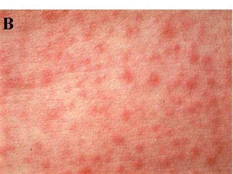 bacterial rash - pictures, photos