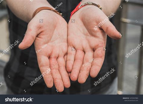 Dyshidrotic Eczema Hands Patient Concept Health Stock Photo 1472937983 ...