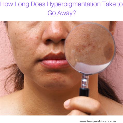 how long does it take for hyperpigmentation to go away