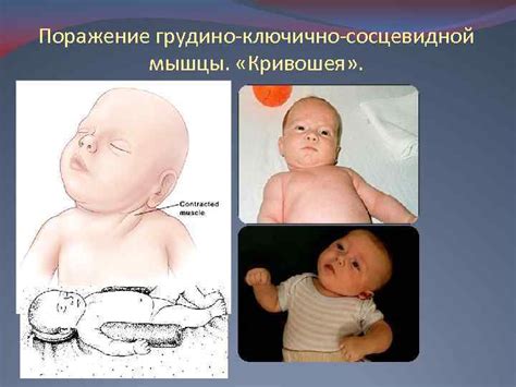 Презентация по педиатрии Тема родовые травмы новорожденных Работу