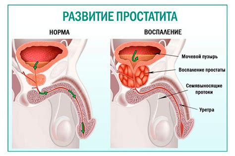 Простатит: причины, симптомы, диагностика и лечение