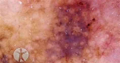 Lentigo maligna melanoma image