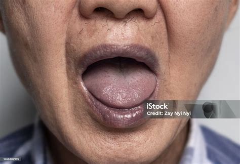 Photo libre de droit de Cyanose Centrale Chez Un Homme Asiatique ...