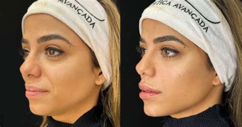Armonizacao Facil Antes E Depois - Key Alves passa por harmonização facial; veja antes e depois