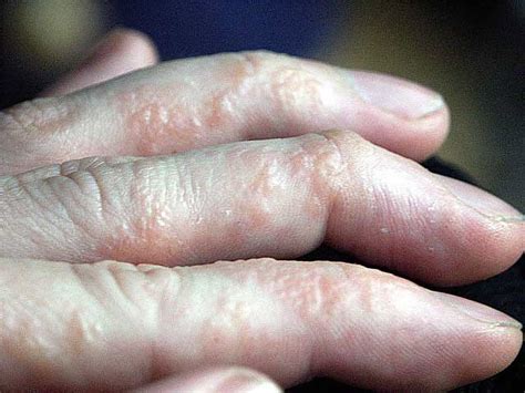 Mild Dyshidrotic Eczema Palms