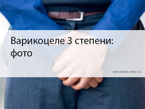 Варикоцеле 3 степени: фото / Клиника лечения варикоцеле №1