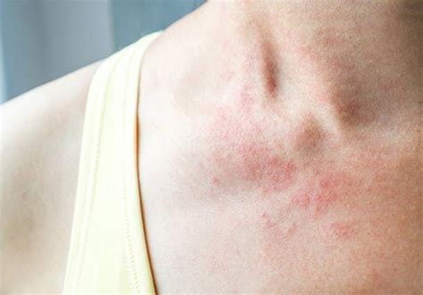 Shingles rash – Artofit