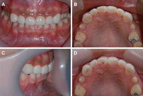 A noninvasive esthetic treatment of isolated microdontia using new high ...