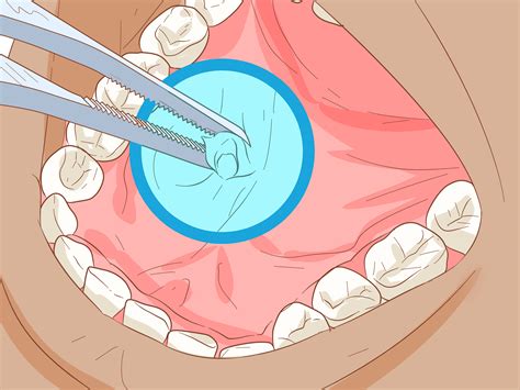 Blocked Parotid Salivary Gland