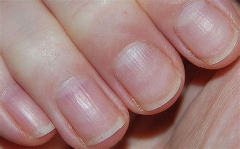 Ongles striés : causes et traitements