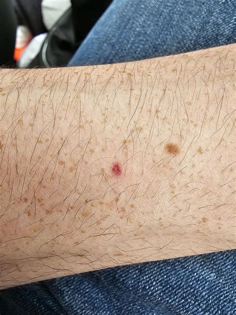Brown Spots On Arm Overnight at Norma Plouffe blog