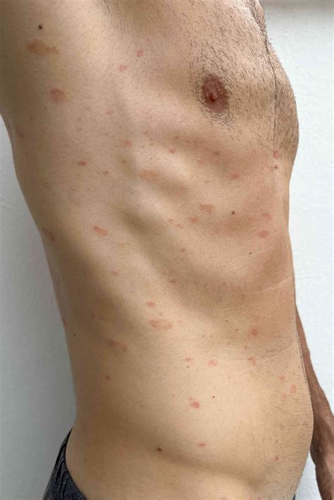 Pitiriasis Alba Tratamiento