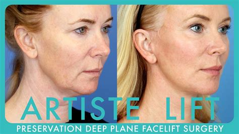 worst day  facelift
