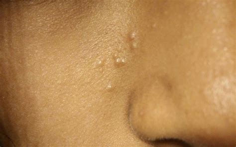 bumps on face that are not pimples