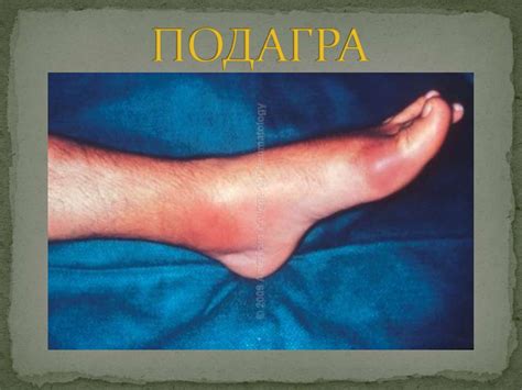 Подагра. Классификация подагры - презентация онлайн