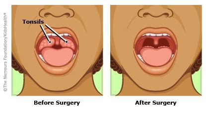 Tonsillectomy | Dayton Children's Hospital