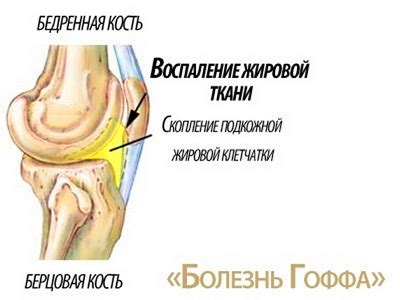 Чем опасна болезнь Гоффа (повреждение жирового тела коленного сустава)?