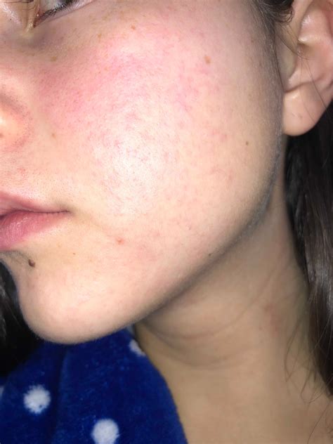 Allergic Reaction To Makeup Rash | Saubhaya Makeup