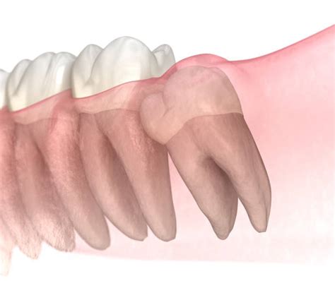 Mesial Angle Stock Photos, Pictures & Royalty-Free Images - iStock