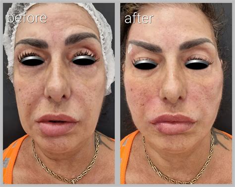 ️Корекция на меките тъкани на... - Haydudova Esthetic Center
