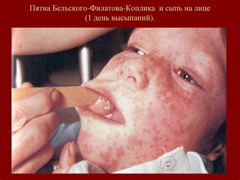 Корь (morbilli) - online presentation