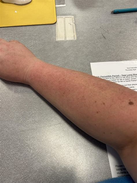 Random red blotchy skin : r/DermatologyQuestions