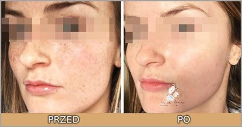 Peeling Przed Czy Po Goleniu? Sprawdź Teraz! - [Zaktualizowano marzec ...