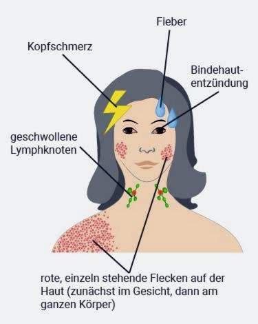 Rubella: simptome, infeksie, behandeling, beskerming