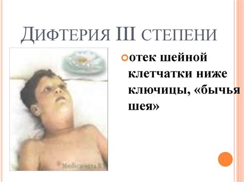 Дифтерия - презентация онлайн