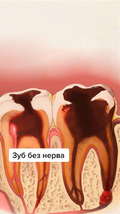 Случай, когда поздно ставить пломбу - YouTube