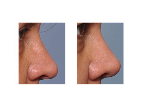 Bony Nose