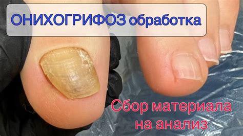😱Онихогрифоз / грибок ногтей / скрученные ногти - YouTube