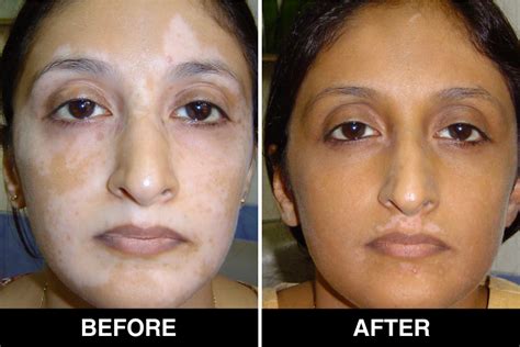 Vitiligo treatment at home - John - Medium