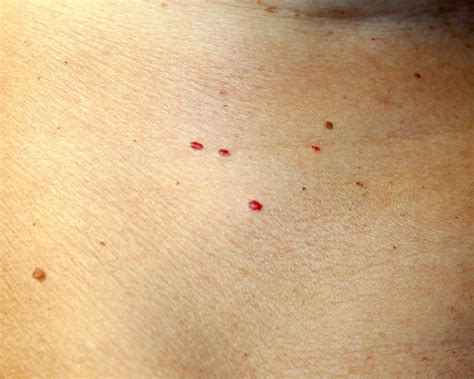 What do these red dots on your skin mean – Artofit